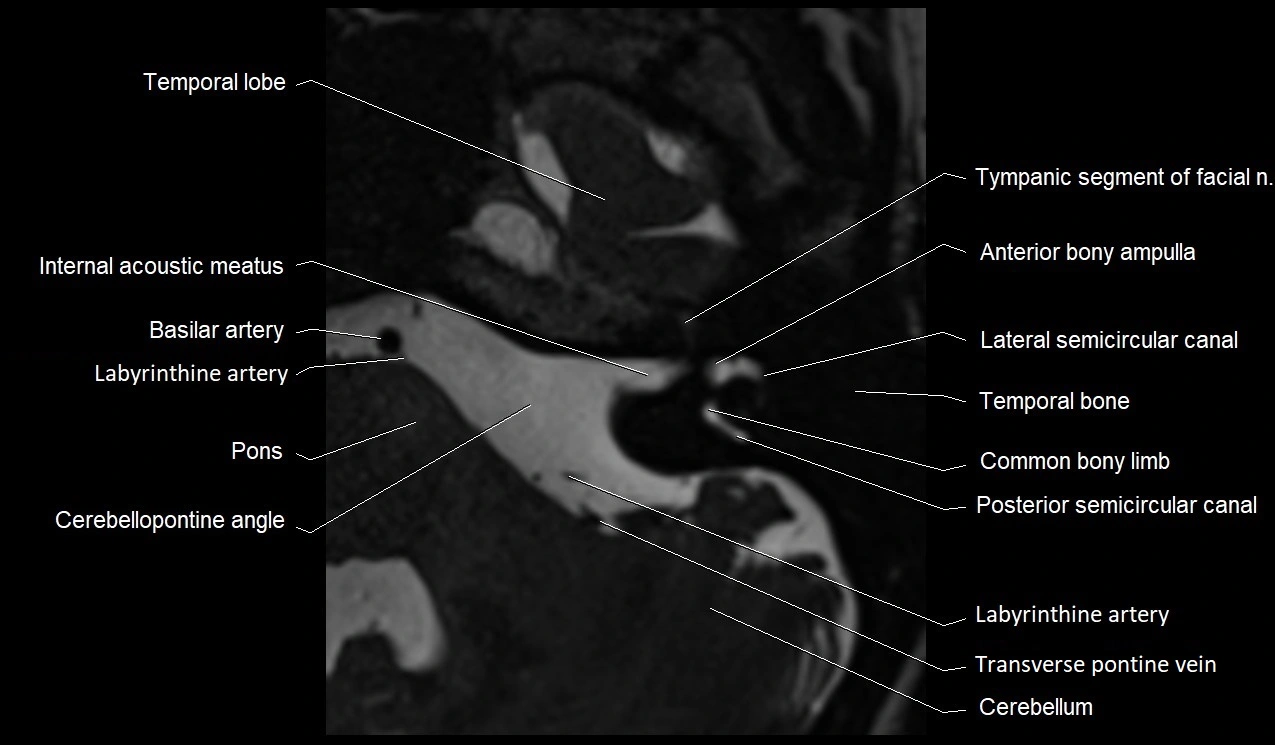 Internal auditory canal (IAC) axial cross sectional anatomy image 17.webp